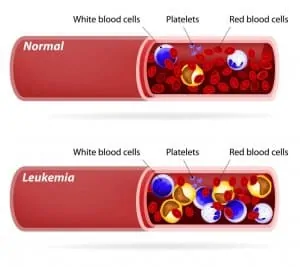 לוקמיה - סרטן הדם